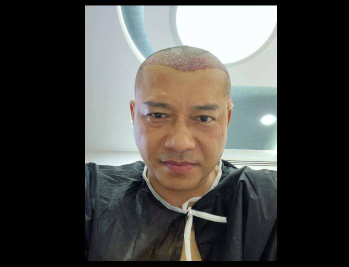 Anang Hermansyah Transplantasi Rambut di Turki, Segini Biayanya