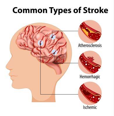 Pentingnya Penurunan Kolesterol Jahat Secara Berkelanjutan, Cegah Serangan Jantung & Stroke