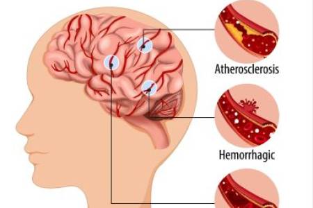 Pentingnya Penurunan Kolesterol Jahat Secara Berkelanjutan, Cegah Serangan Jantung & Stroke